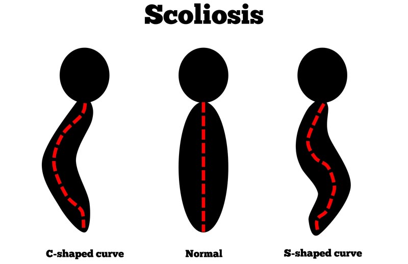 Providence, RI scoliosis treatment